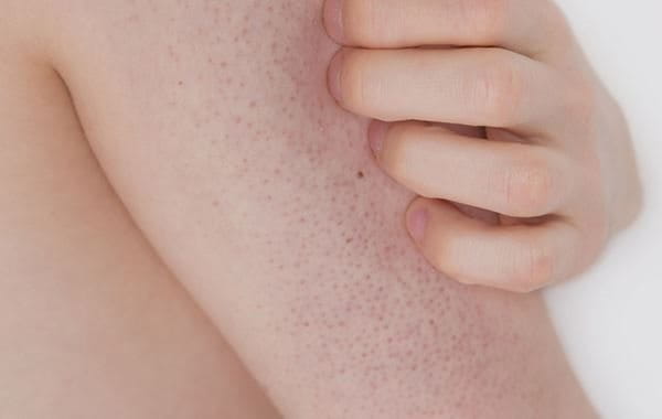 Eucerin keratosis pilaris hotsell